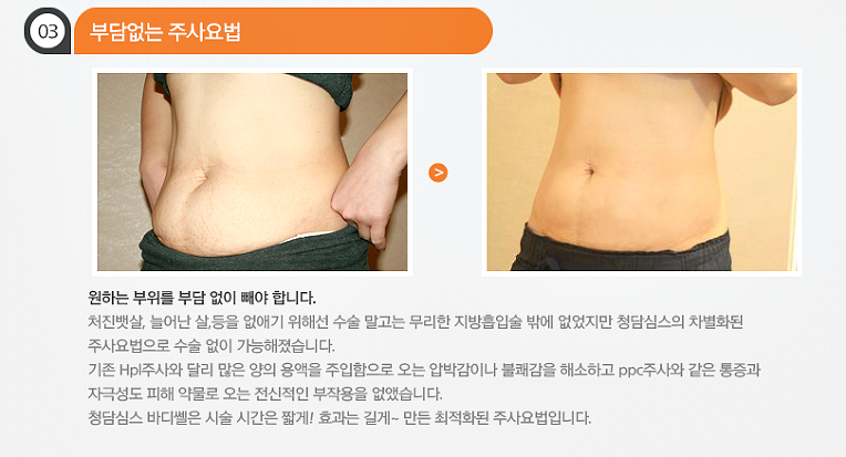 강릉 비만주사 바디쎌주사로 날씬하게 